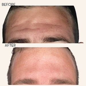Botox Wrinkle Relaxer Treatments