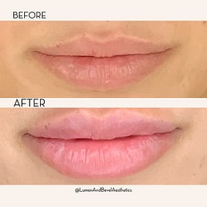 Lip Injections